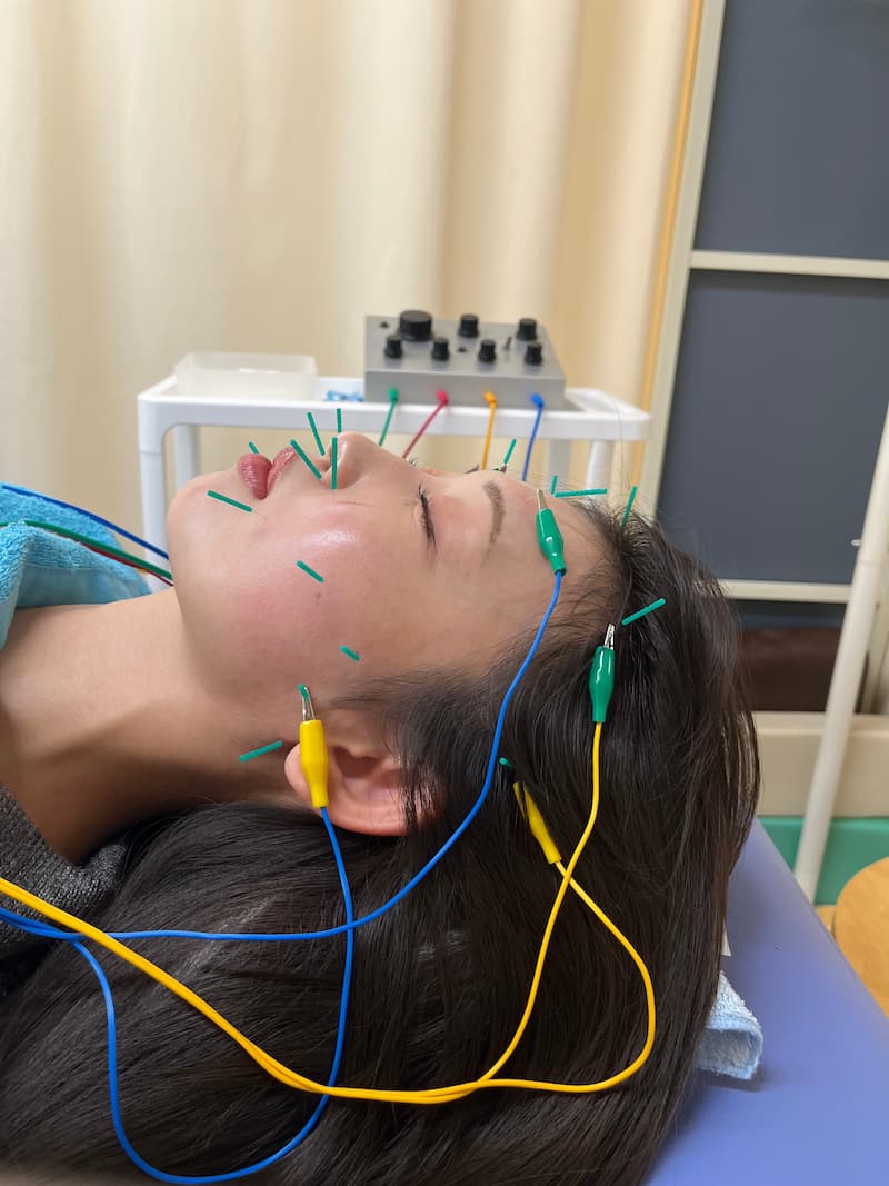 プレミアム美容鍼